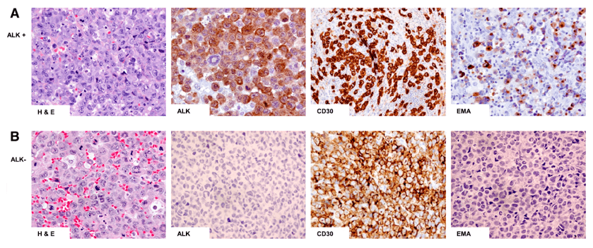 Hematoxylin and eosin (H&E) and immunohistochemical staining of ALCL. (Hapgood, 2015)