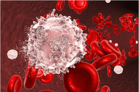 Acute myeloid leukemia (AML) is a cancer of the blood and bone marrow. 
