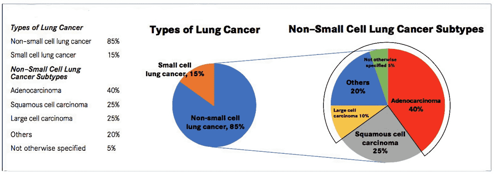 Types of lung cancer by histology.