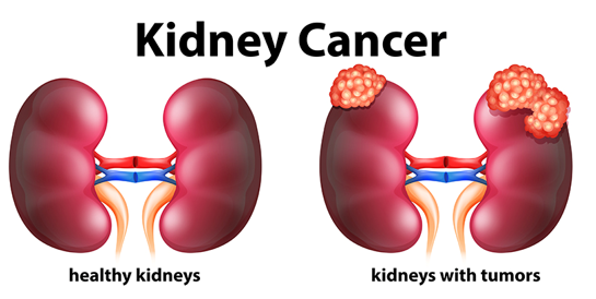 Renal cancer (kidney cancer). 