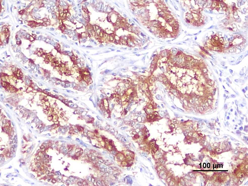 Tubulopapillary carcinoma TGFβ expression. (Carvalho, et al., 2024) (OA Literature)