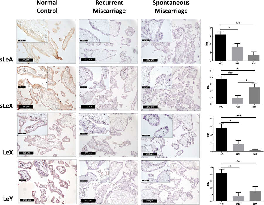 Fig 3. Immunohistochemical staining of four carbohydrate Lewis antigens in the syncytiotrophoblast of three groups of placenta tissues. (OA Literature)