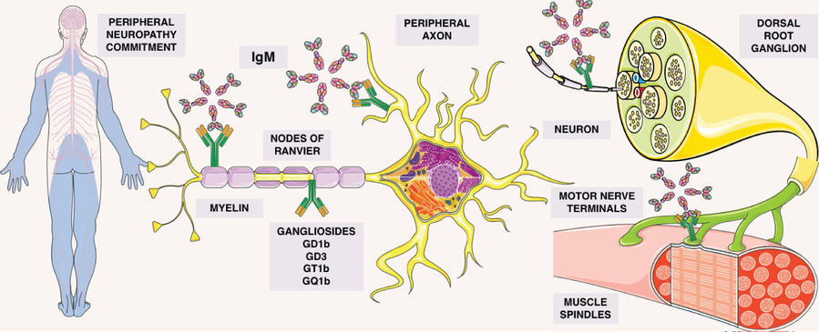Fig.1 The figure illustrates gammopathy's role in peripheral neuropathy: ganglioside binding to key neural sites allows IgM adhesion, with autoimmunity driving the condition. (OA Literature)