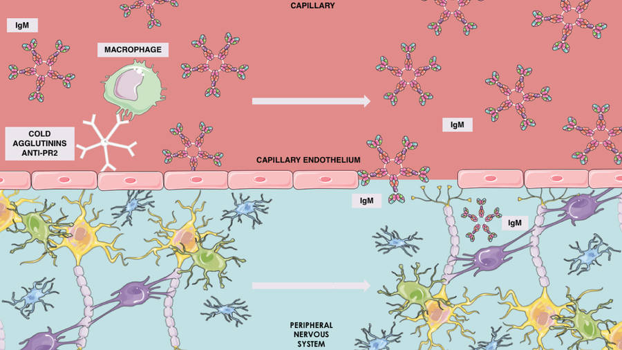 Fig.2 Illustration of how cold agglutinins (anti - Pr2) and IgM interact with capillary endothelium, enabling IgM to access and impact the peripheral nervous system, contributing to CANOMAD syndrome pathogenesis. (OA Literature) 