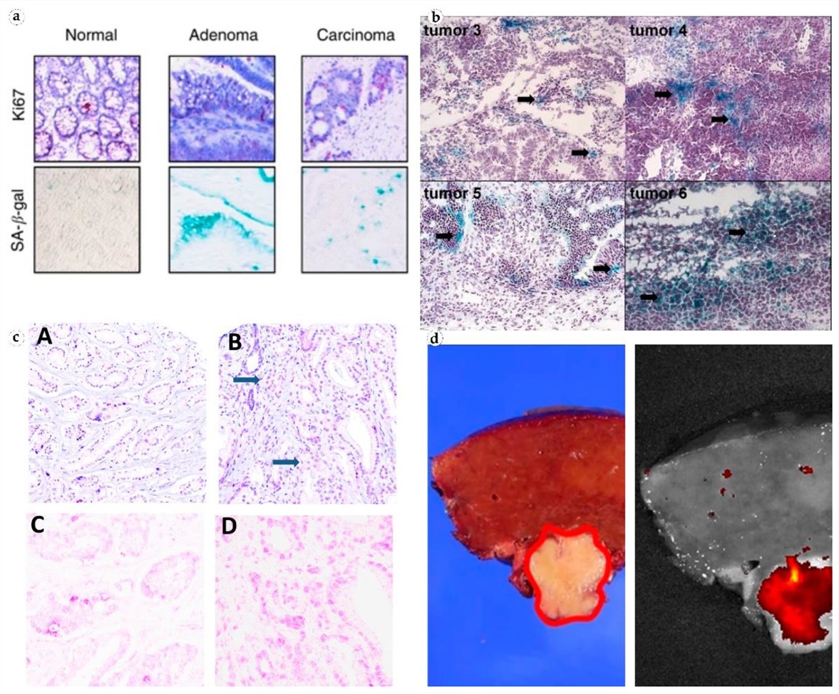 Fig.1 Immunohistochemical staining of SA-beta-gal expression in human colorectal and prostate tumor tissues indicating cellular senescence. (OA Literature)