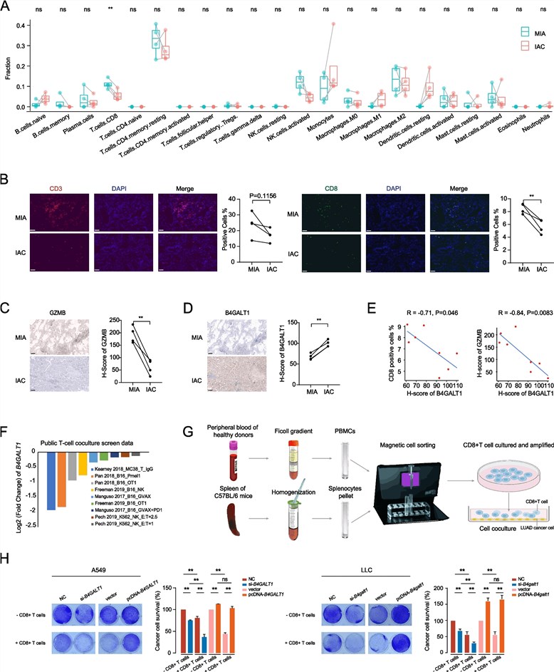 Fig.1 Composite analysis demonstrating the immunosuppressive role of B4GALT1, including immune profiling showing reduced CD8+ T cells in invasive tumors, immunohistochemistry revealing an inverse correlation between B4GALT1 and Granzyme B levels, and co-culture assays confirming B4GALT1-mediated inhibition of T-cell cytotoxicity. (OA Literature)