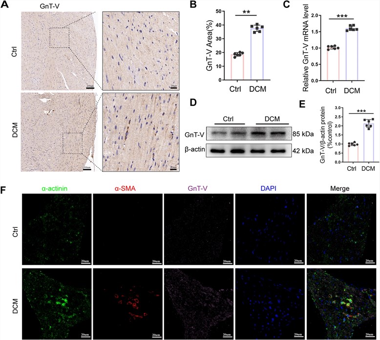 Fig.1 Immunohistochemistry staining of mouse cardiac tissue showing upregulated GnT-V expression in diabetic cardiomyopathy compared to control. (OA Literature)