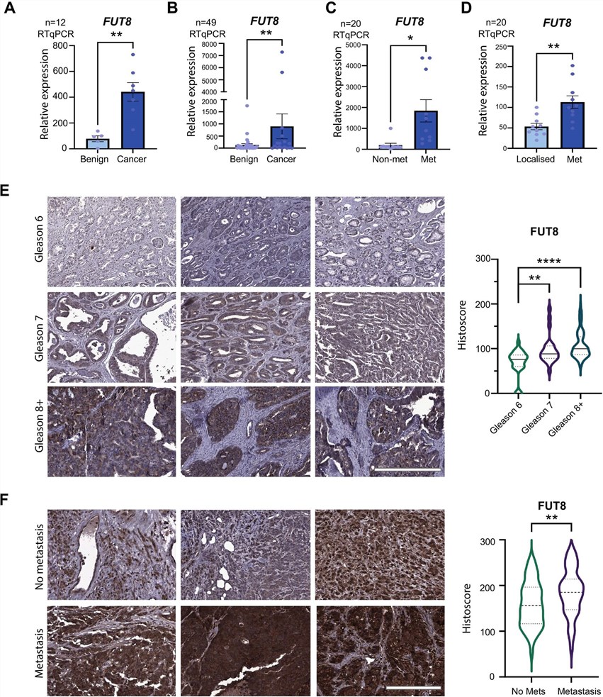 Fig.1 Immunohistochemistry analysis showing elevated FUT8 protein levels in Gleason grade 8 prostate cancer tissues compared to low-grade tissues. (OA Literature)