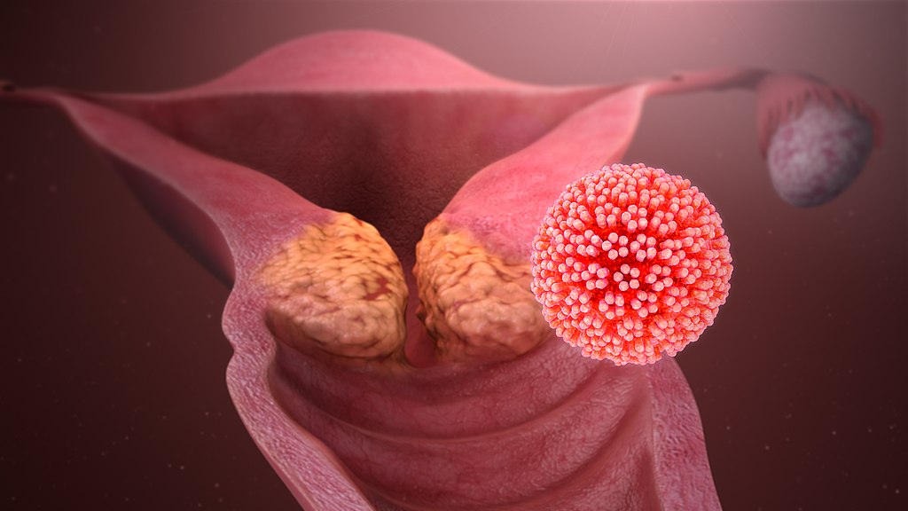 Cervical cancer caused by HPV.