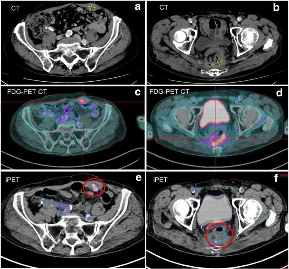 MImaging workup of multiple liver metastases only visualized by immuno-PET. (Touchefeu, et al., 2021)