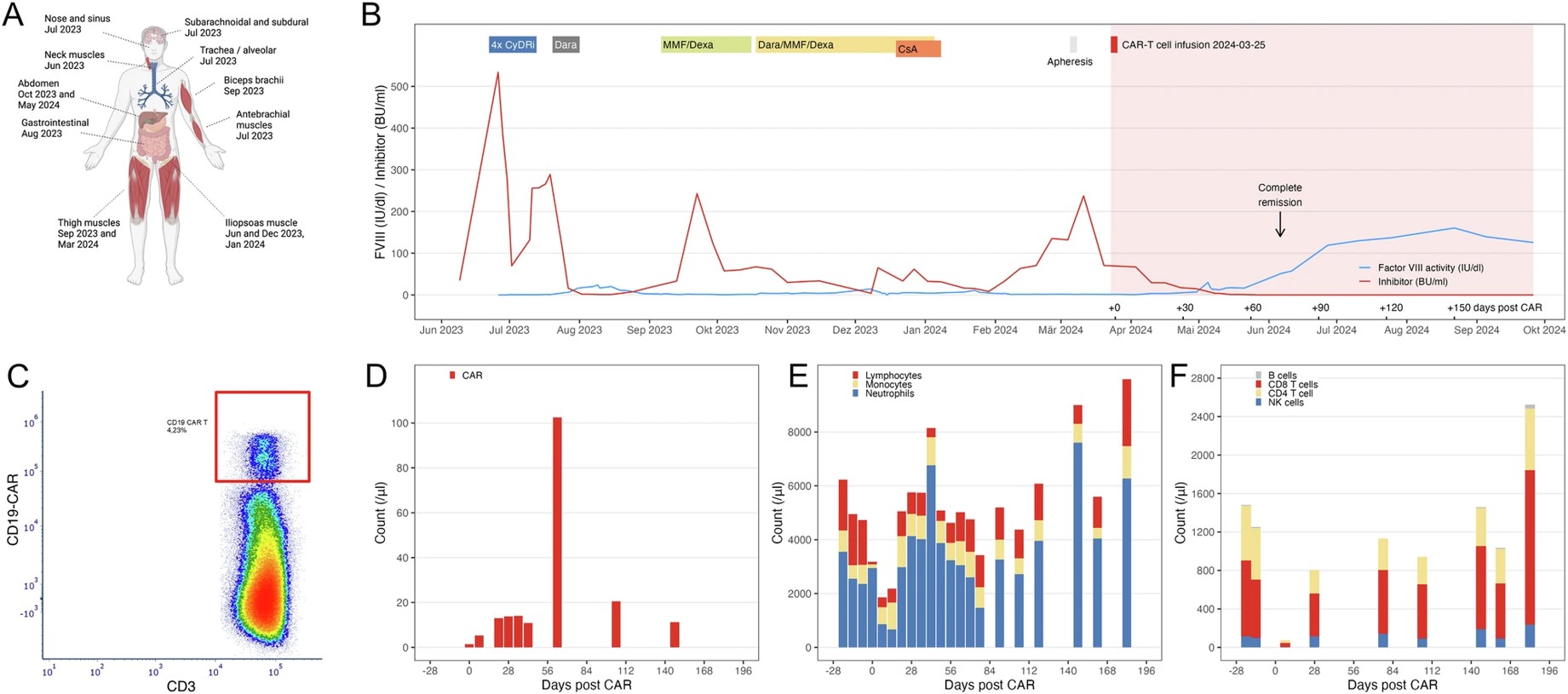 Fig.2 Impact of anti-CD19 CAR-T cells on acquired hemophilia. (OA Literature)