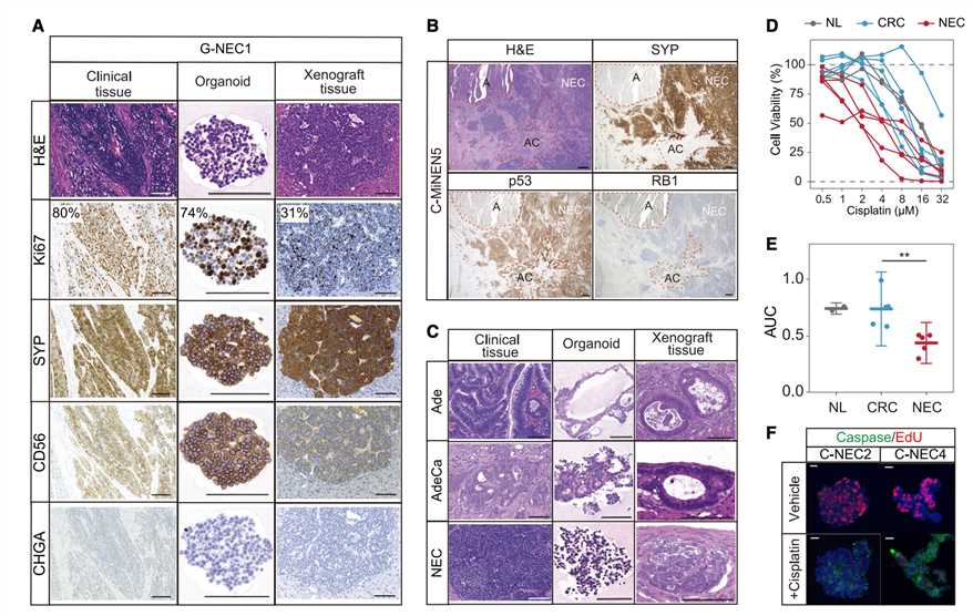 Histomophologically characterization of patient-derived GEP-NEC organoids and their sensitivity to drugs.