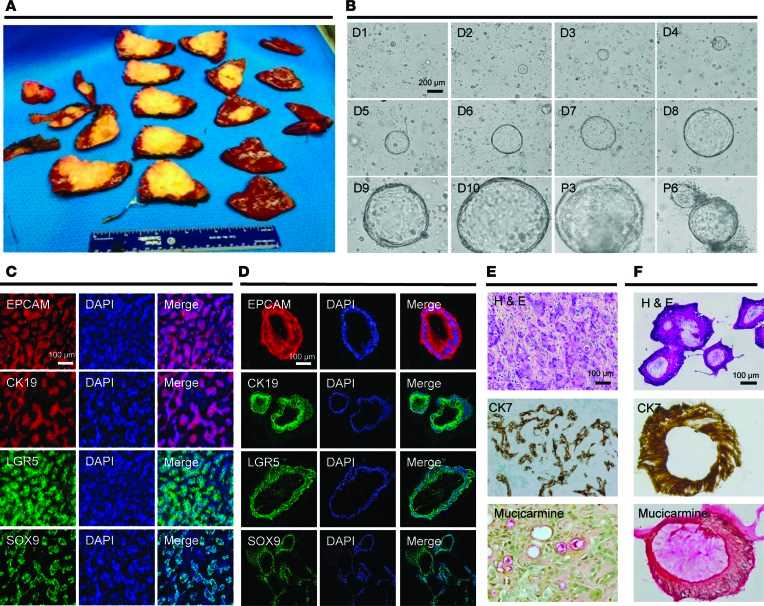 Cystic organoids are established from human intrahepatic CCA (iCCA) and mimic the features of the primary tumor.