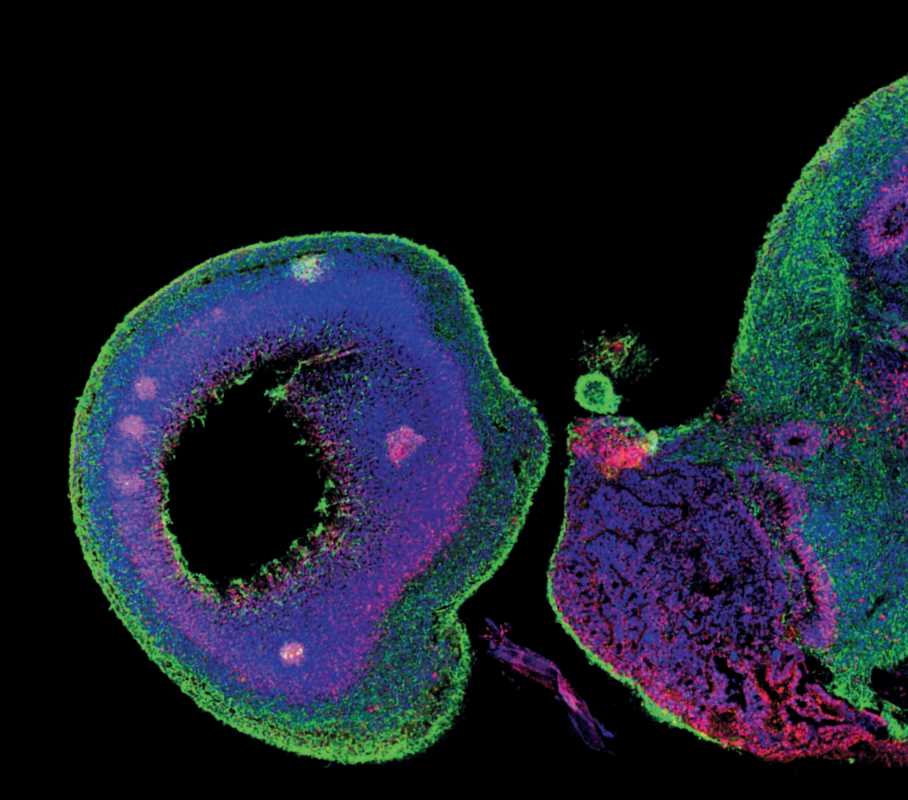 Brain Cancer Organoid Models
