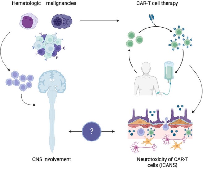 Fig.1 CART cell associated neurotoxicity. (OA Literature)