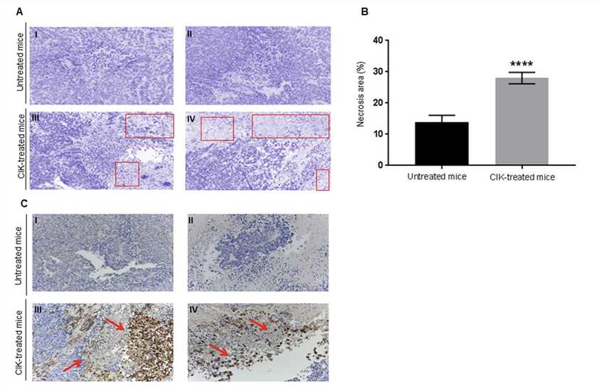 Tumor Necrosis and Infiltration by CIK In Vivo.