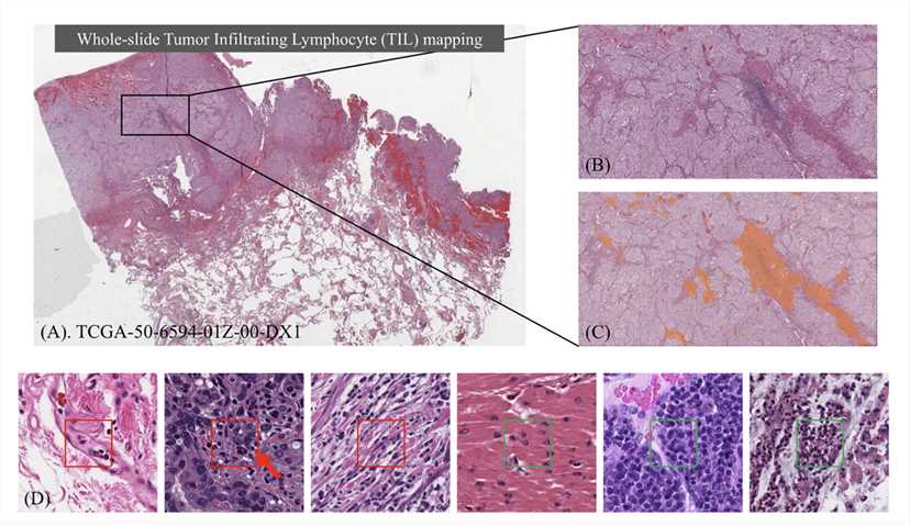Identifying Tumor Infiltrating Lymphocyte (TIL) Tegions in Gigapixel Pathology WSIs.