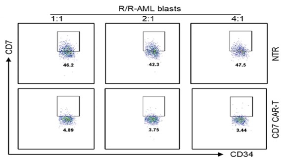 The primary CD7+ R/R-AML blasts exhibit cytotoxicity due to the presence of CD7 CAR.