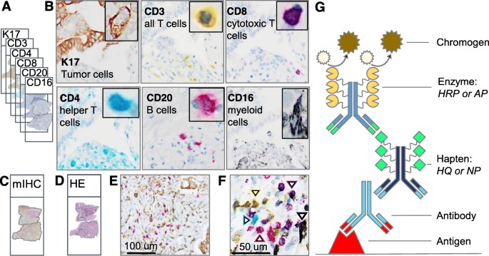 IHC markers in the pancreatic ductal adenocarcinoma (PDAC) mIHC panel to study tumor immune interactions. 
