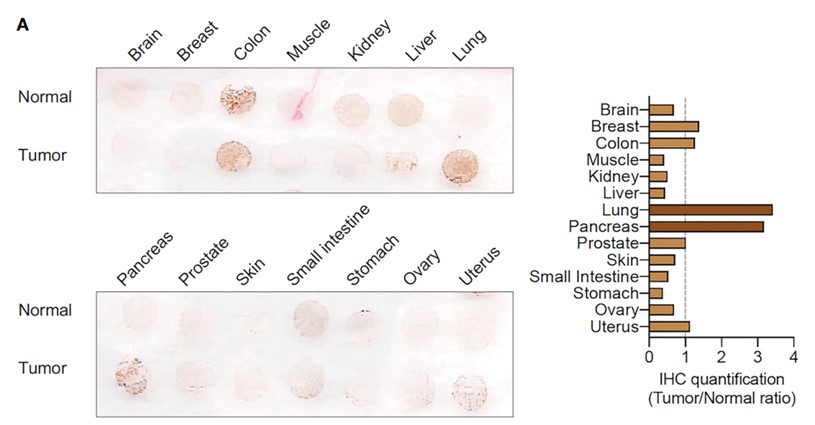 Fig.1 Expressions of CEACAM5 in different normal or tumor tissues. (Kim, et al., 2023)