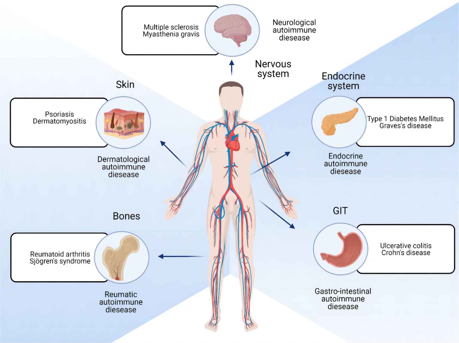 Fig. 1 Illustration of autoimmune disease. （Glover et al., 2021)