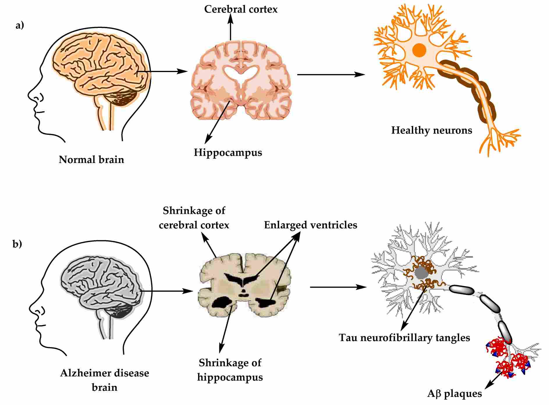 Schematic of the physiological structure of the brain and neurons in the healthy brain and the Alzheimer’s disease brain. (OA Literature)