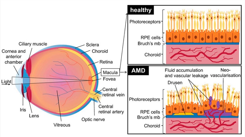 Schematic of the eye with healthy retina, choroid, and retinal pigment epithelium (RPE) cells and effects of AMD.