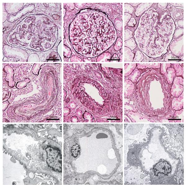 Pathological changes observed in kidney biopsies of a patient with aHUS pre- and post-eculizumab treatment.