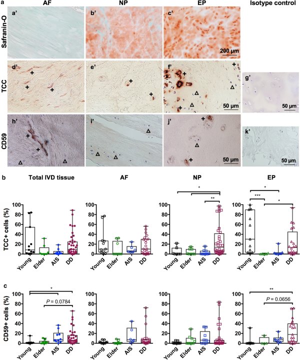Terminal complement complex formation is associated with intervertebral disc degeneration.