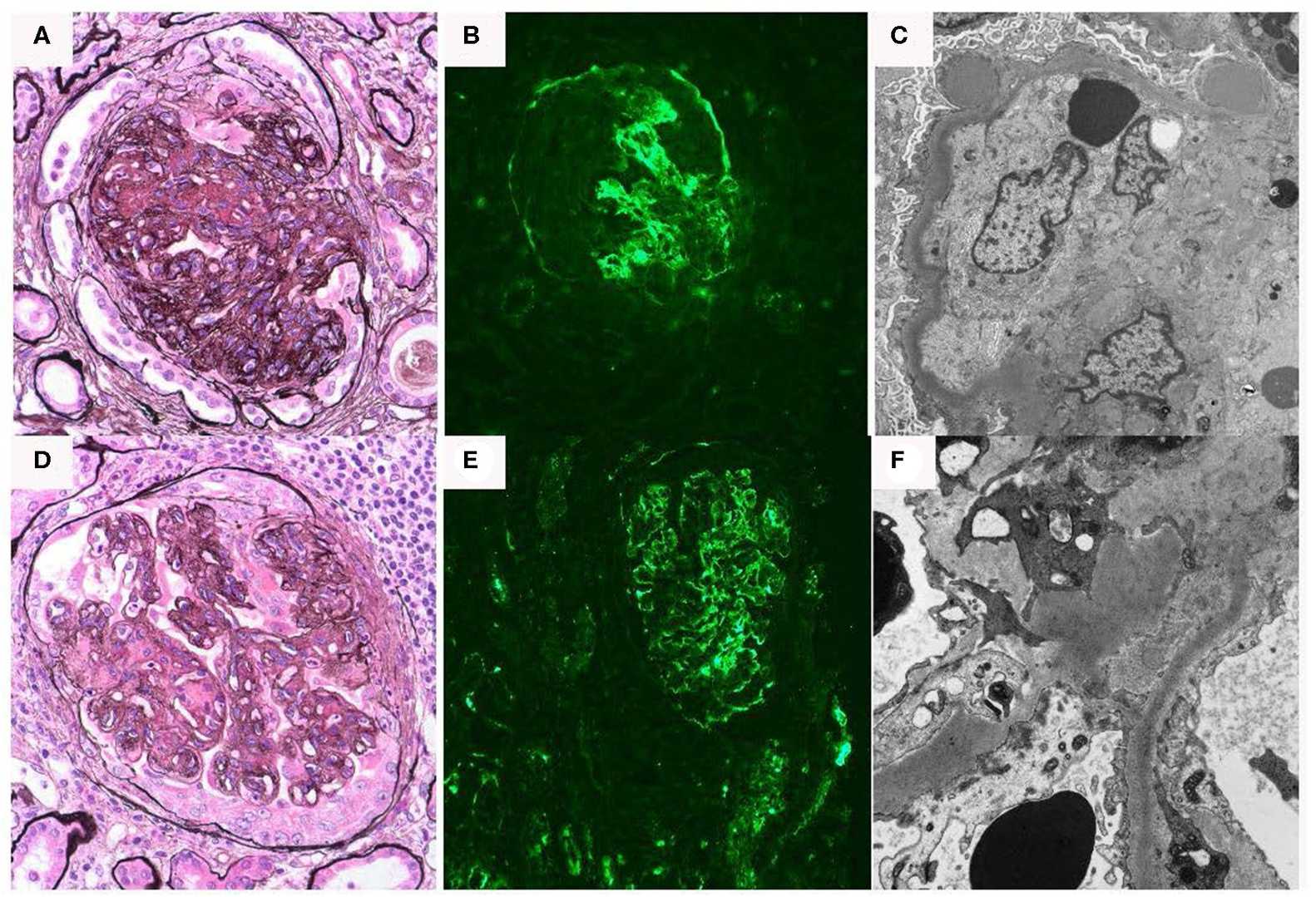 Fig. 1 Kidney biopsy findings of C3 glomerulopathy. (Hanna, et al., 2020)