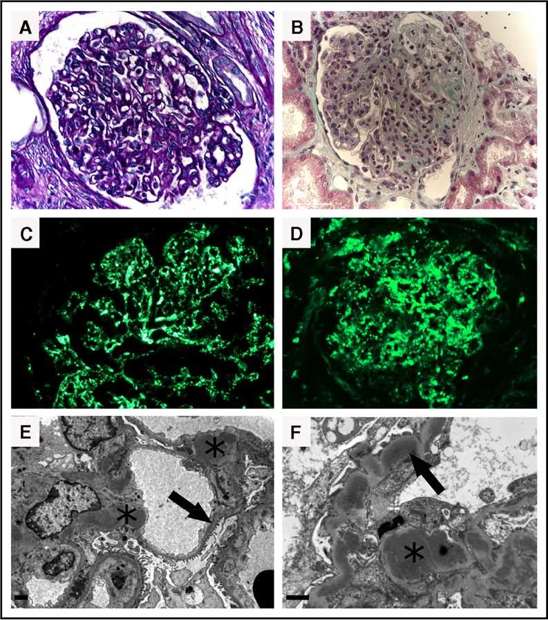 Kidney biopsy findings of C3 glomerulopathy.