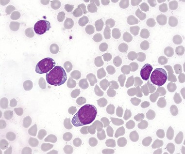 T-lymphoblastic cells of acute leukemia in the bone marrow.