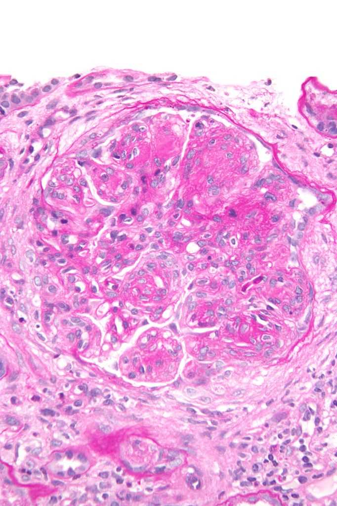 Fig 1. Mesangial proliferative glomerulonephritis. （By Nephron - Own work, https://commons.wikimedia.org/wiki/File:Membranoproliferative_glomerulonephritis_-_very_high_mag.jpg)