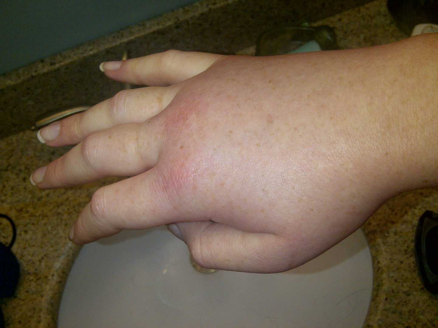 Swollen right hand in a female patient during a hereditary angioedema attack. (By LucyHAE - Own work, CC BY-SA 3.0, https://commons.wikimedia.org/w/index.php?curid=22728152)