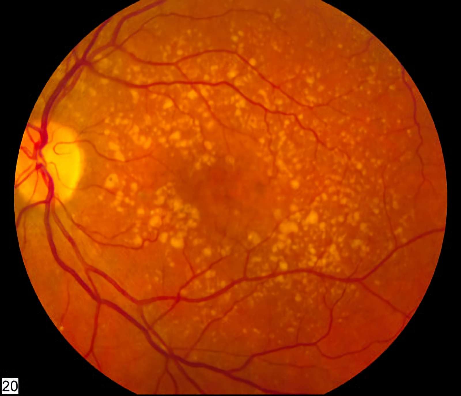 Fig. 1 Age-related macular degeneration. There are irregular pale dots at the macula, which are called drusen. （From Wikipedia: https://commons.wikimedia.org/wiki/File:Intermediate_age_related_macular_degeneration.jpg)