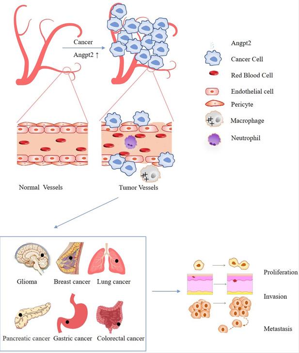 The increase of ANGPT2 in cancer leads to vascular instability, increases leakiness of the vessels, limits immune cell trafficking, and finally promotes cancer progression.