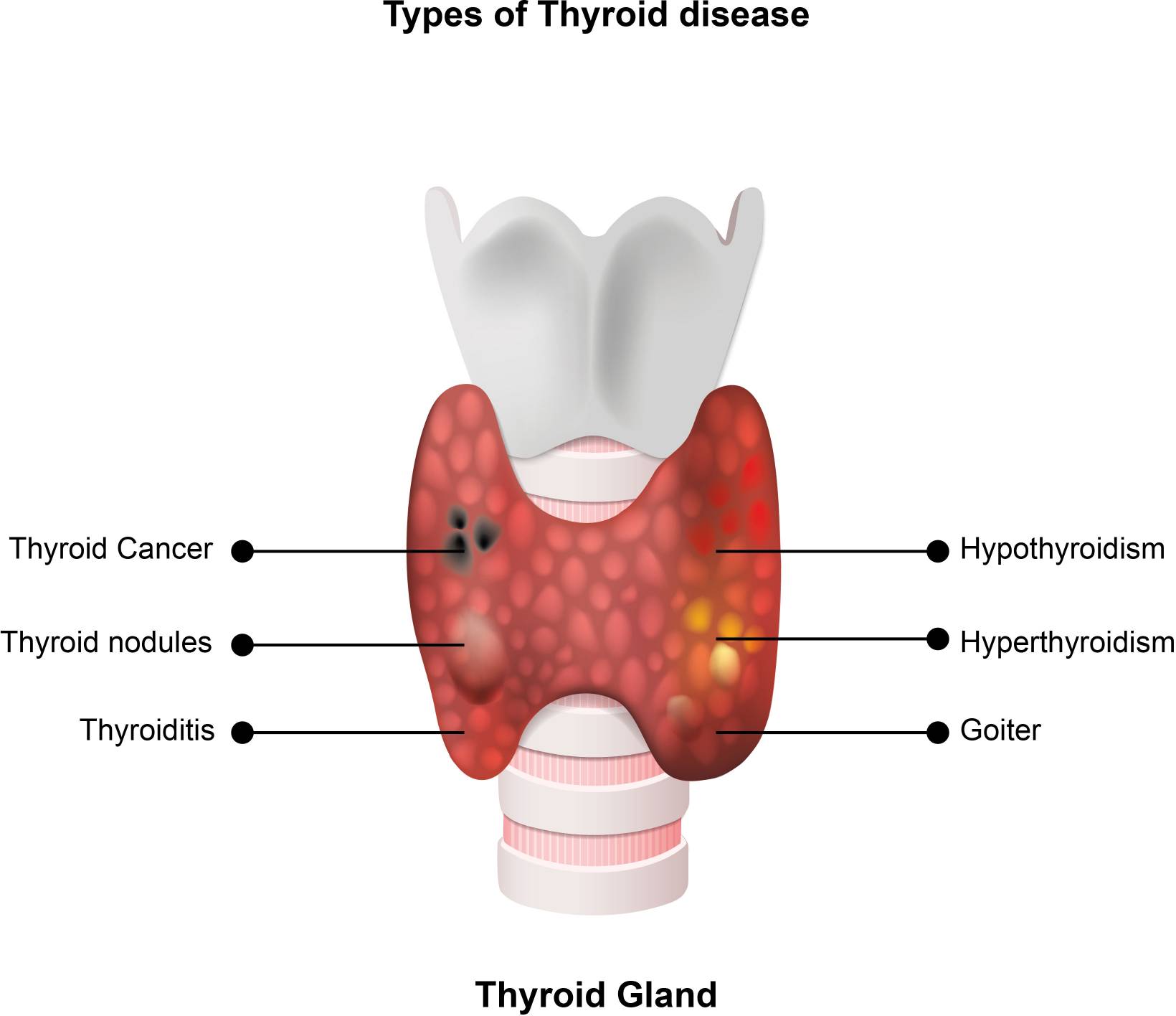 Fig. 1 Hashimoto’s disease/ thyroiditis is one of thyroid diseases. （Macvanin et al., 2023)