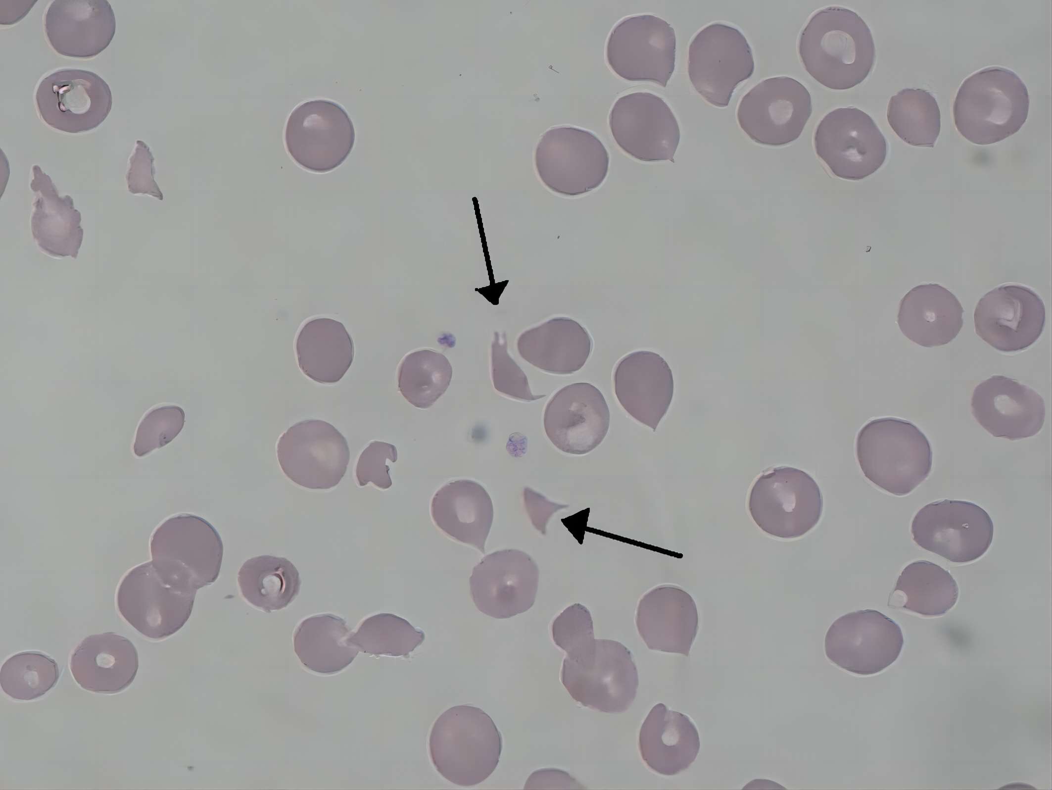 Fig. 1 Schizocytes in hemolytic-uremic syndrome. （By Paulo Henrique Orlandi Mourao - Own work, https://commons.wikimedia.org/wiki/File:Schizocyte_smear_2009-12-22.JPG)
