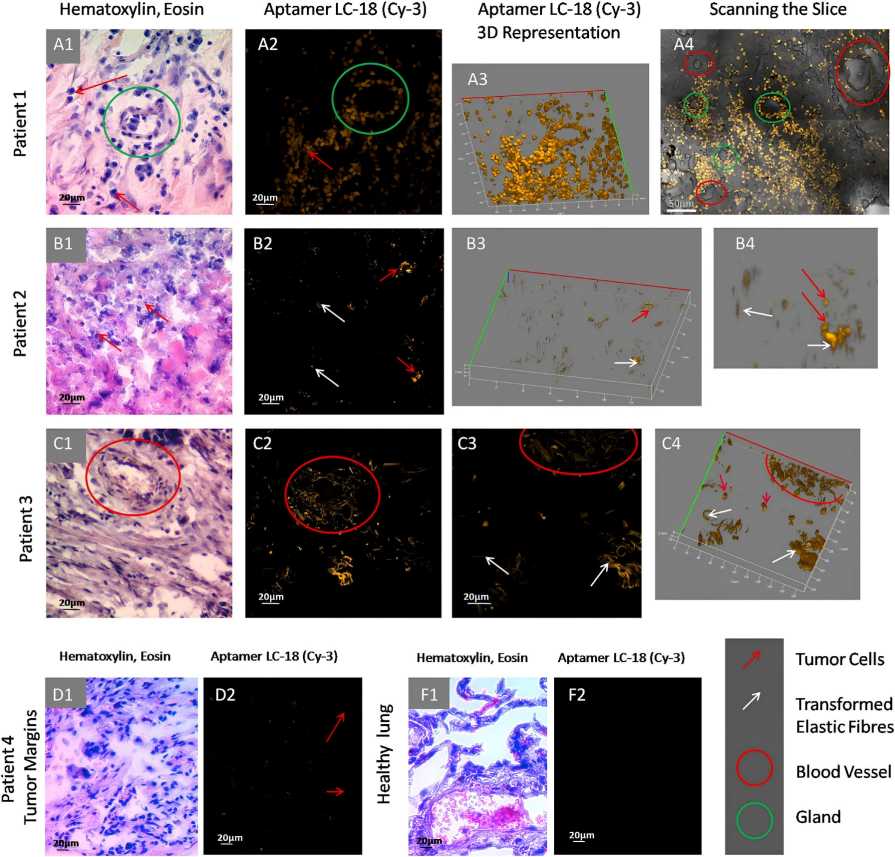 Fig.2 Laser-scanning and light microscopy imaging of anti-lung adenocarcinoma tissue aptamer binding to transformed elastic fibers in tumor blood vessels. (Zamay, et al., 2017)