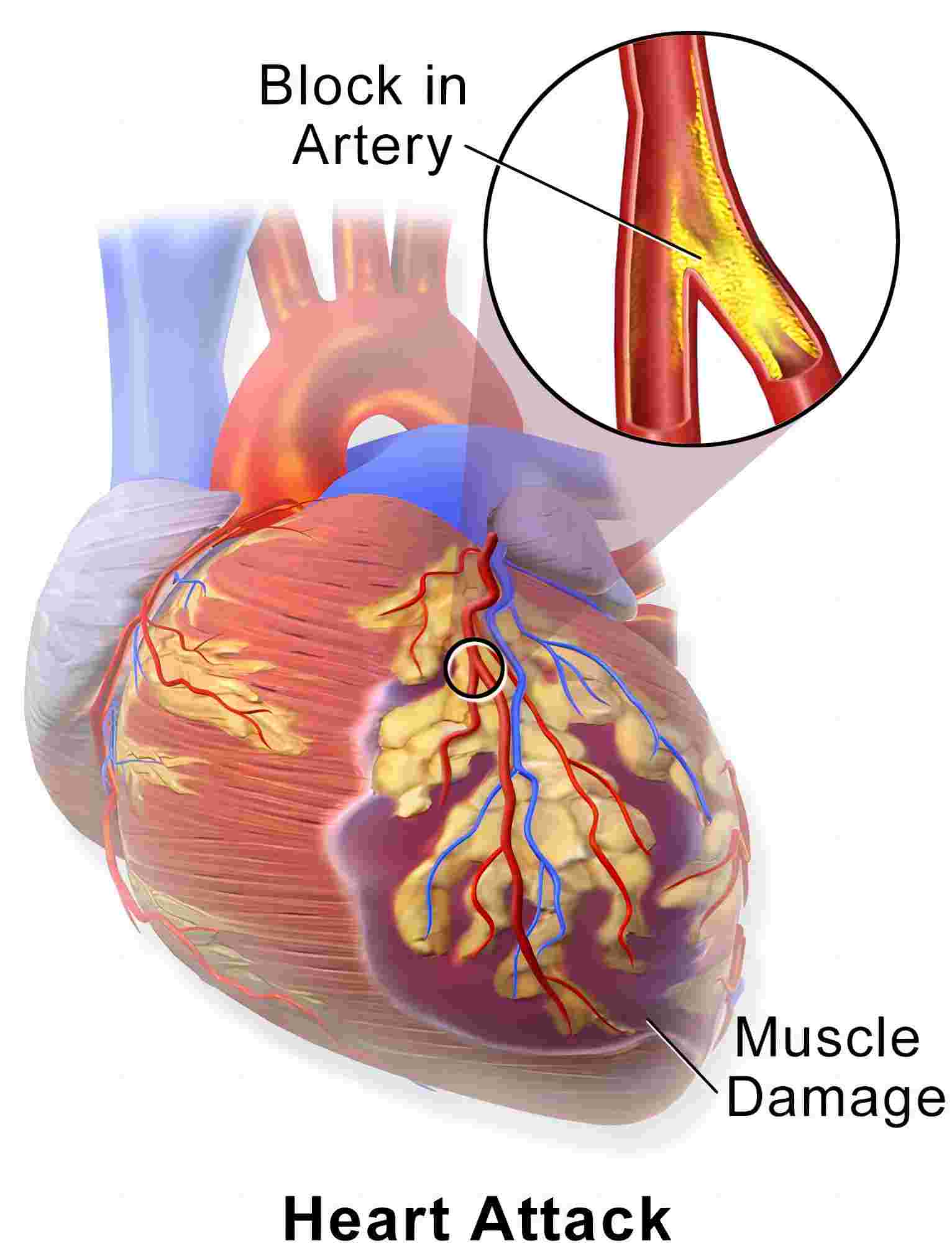 Fig. 1 The schematic diagram of myocardial infarction. （By Blausen Medical Communications, https://commons.wikimedia.org/wiki/File:Blausen_0463_HeartAttack.png)