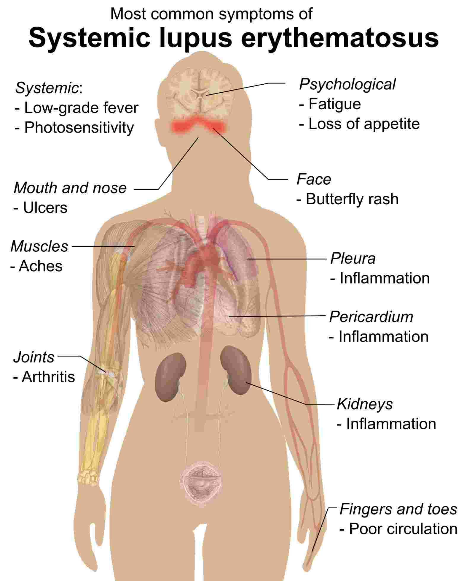 Fig. 1 The illustration of systemic lupus erythematosus. （Häggström, 2014)