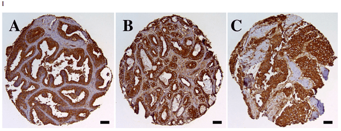 Microphotographs of human prostate tissue samples stained with CD164.