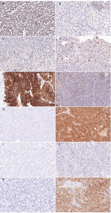 Representative images of immunostaining in parathyroid carcinoma tissue samples.