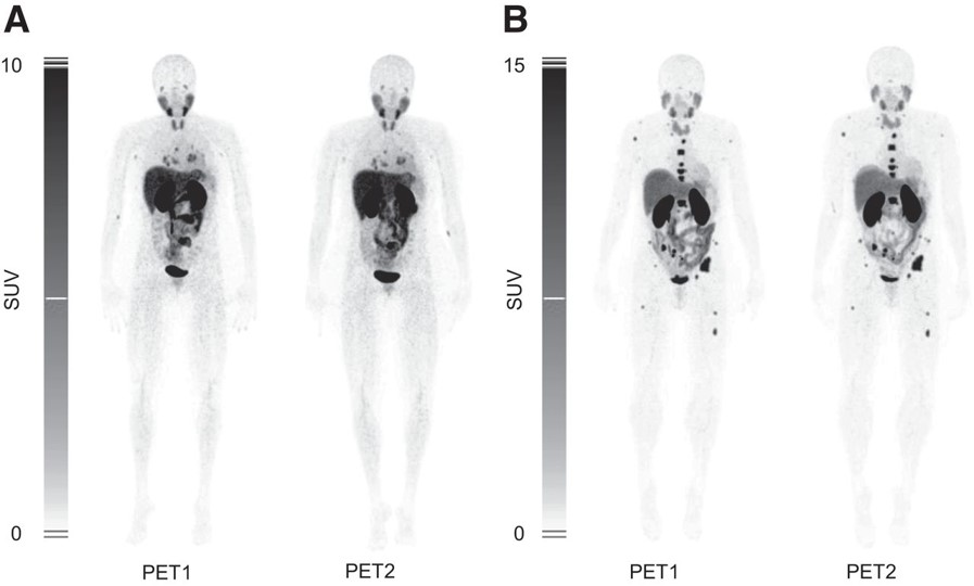 Tracer biodistribution and uptake of HER2-negative patients who were injected twice with [68Ga]Ga-NOTA-anti-HER2-sdAb.