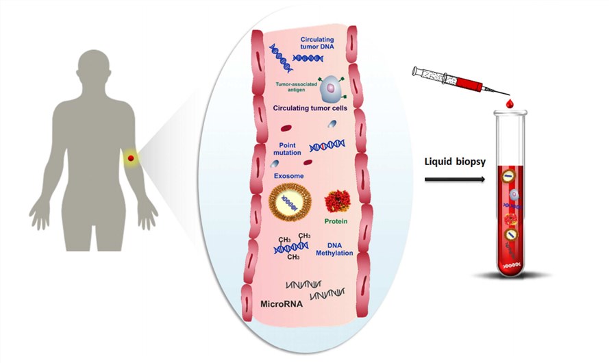 Schematic representation of cancer-related biomolecules such as cells, proteins, nucleic acids and microvesicles circulating into the bloodstream, and collection of these biomarkers by liquid biopsy.