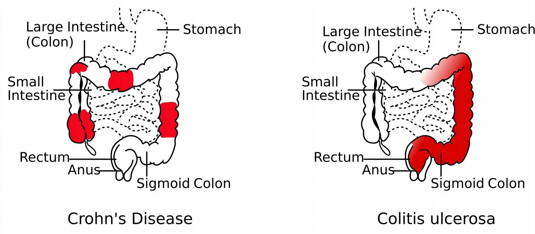 Fig.6 Crohn’s disease. (From Wikipedia: Own work, this file was derived from: Patterns of Crohn's Disease.svg by Samir, https://commons.wikimedia.org/wiki/File:Crohn%27s_Disease_vs_Colitis_ulcerosa.svg)