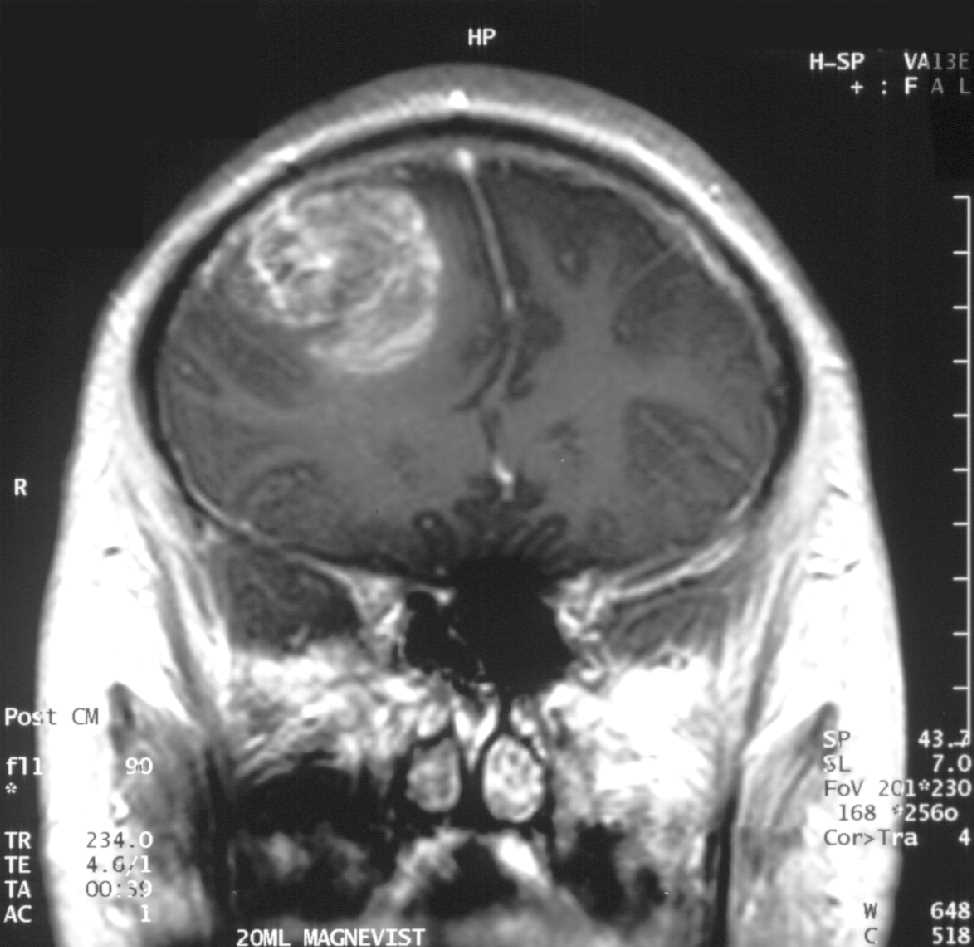 Fig.9 Glioblastoma. (From Wikipedia: By Christaras A - Created myself from anonymized patient MR, https://commons.wikimedia.org/wiki/File:Glioblastoma_-_MR_coronal_with_contrast.jpg)