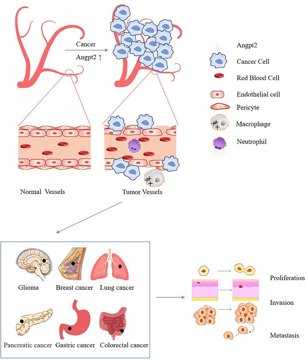 The effect of ANGPT2 dysregulation on cancer cells. (Liu, et al., 2022)