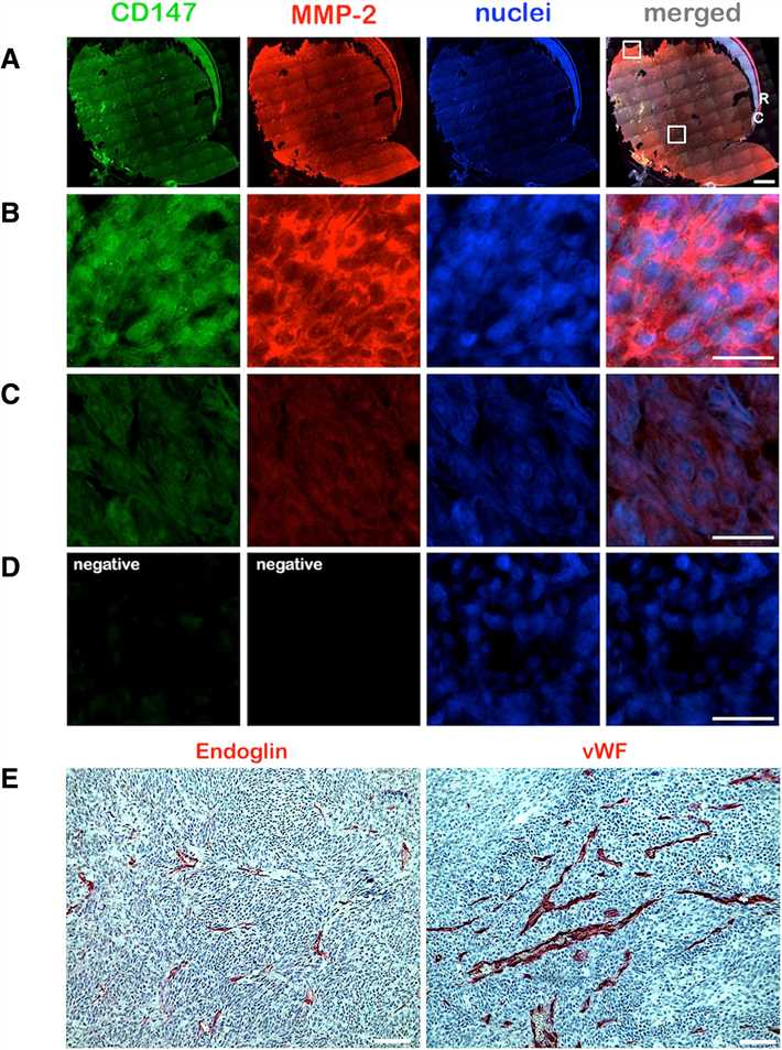 Fig.3 CD147 and MMP-2 expression in primary uveal melanoma. (Lüke, et al., 2016)