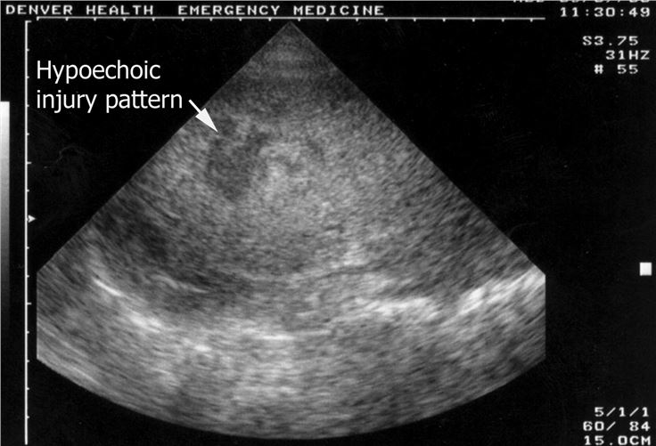 Ultrasound image of a solid organ injury seen as a hypoechoic region within the parenchyma.
